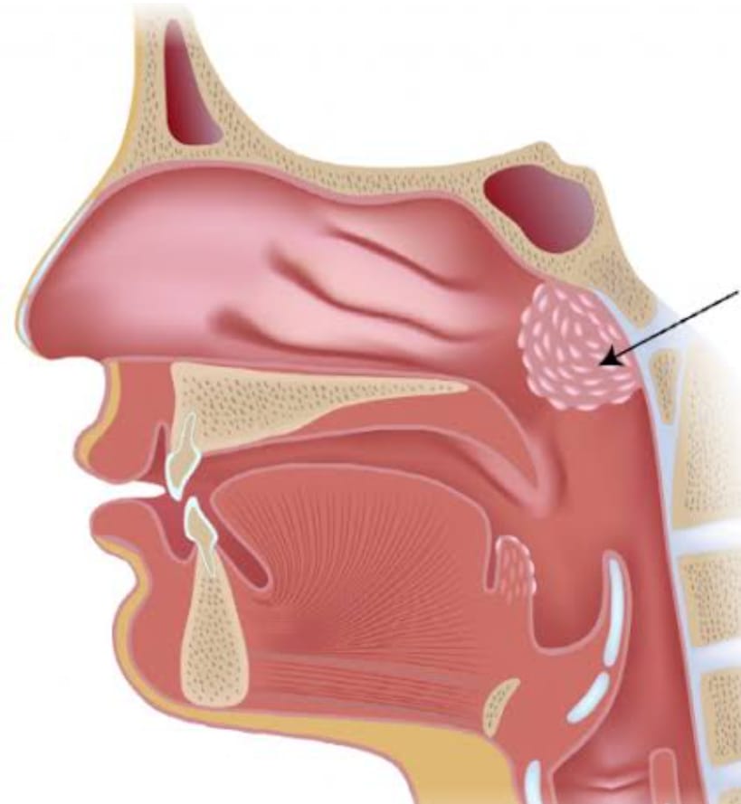 Adenoid surgery (cold Steel or coblation)