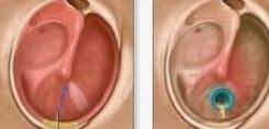Ear Fluid Drainage (Myringotomy)