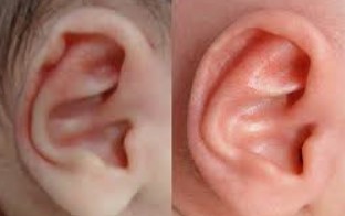 Preauricular Tag Removal