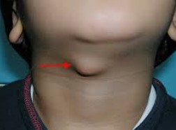 Thyroglssal Fistula /Cyst