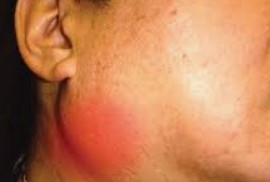 Submandibular Stone /Lump/Cancer Removal