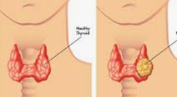 Thyroid Lump / Cancer Removal