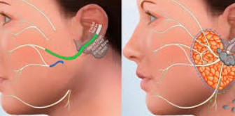 Parotid Lump / Cancer Removal