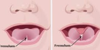 Tongue Tie release surgery