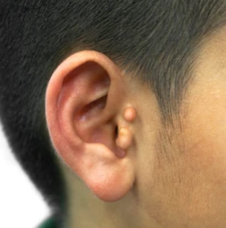 Ear Reshaping (Pinna plasty)