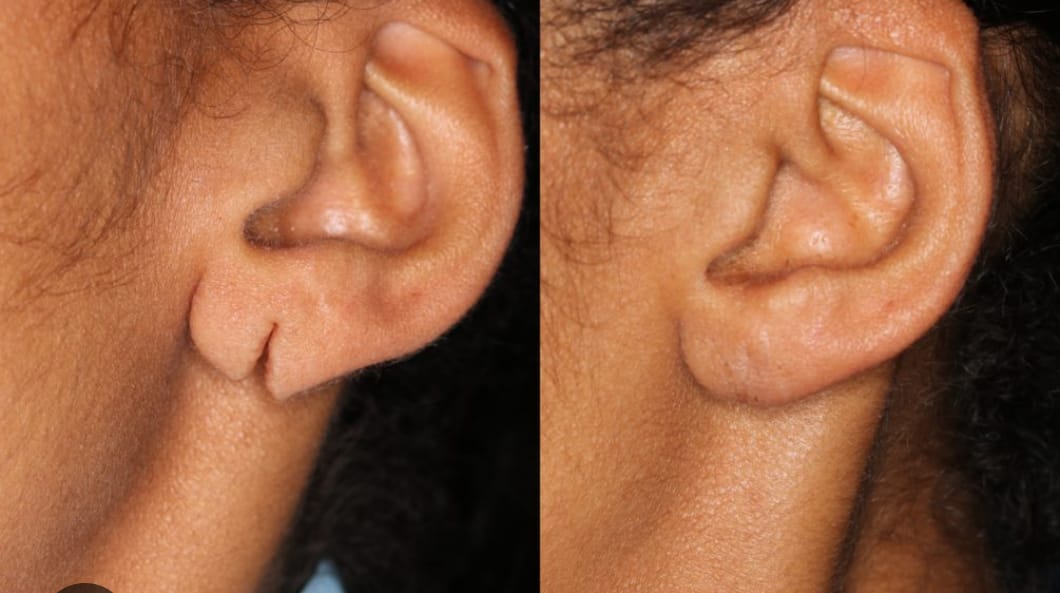 Split Ear Lobule
