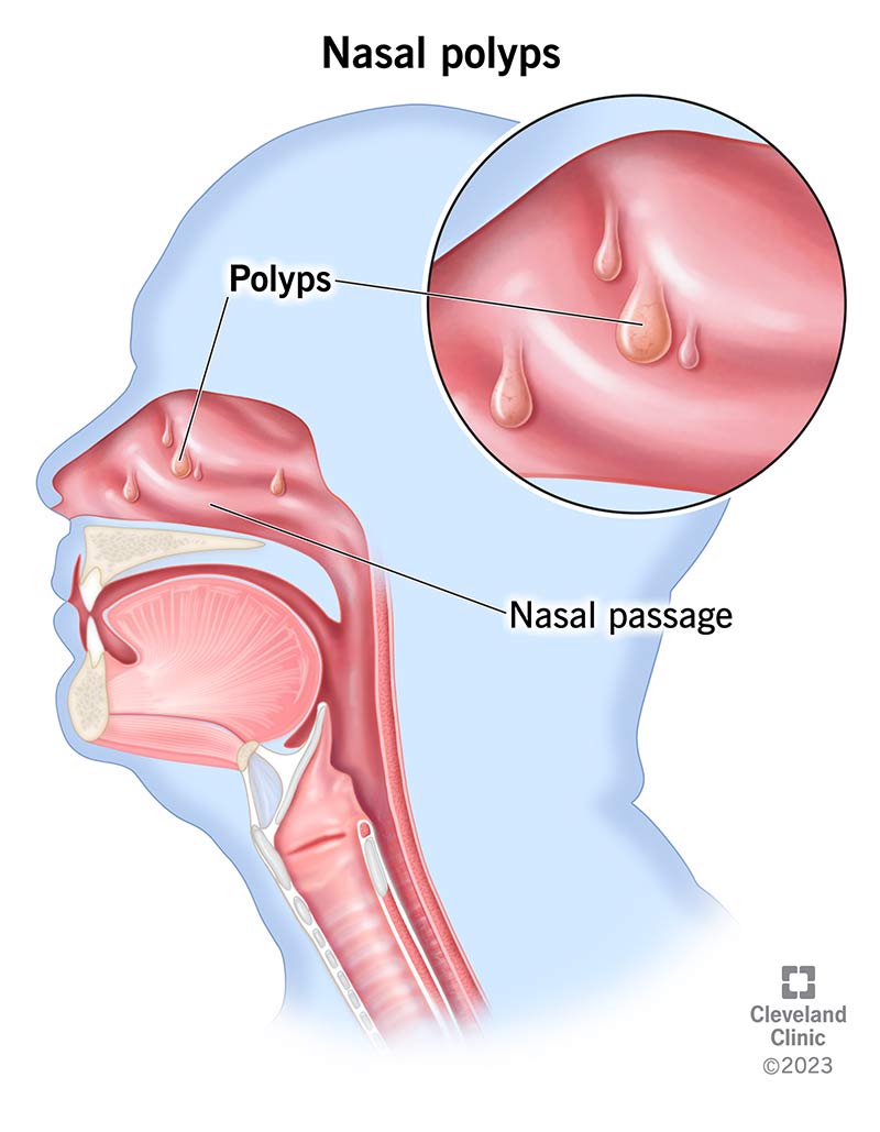 Nose Polyp Removal