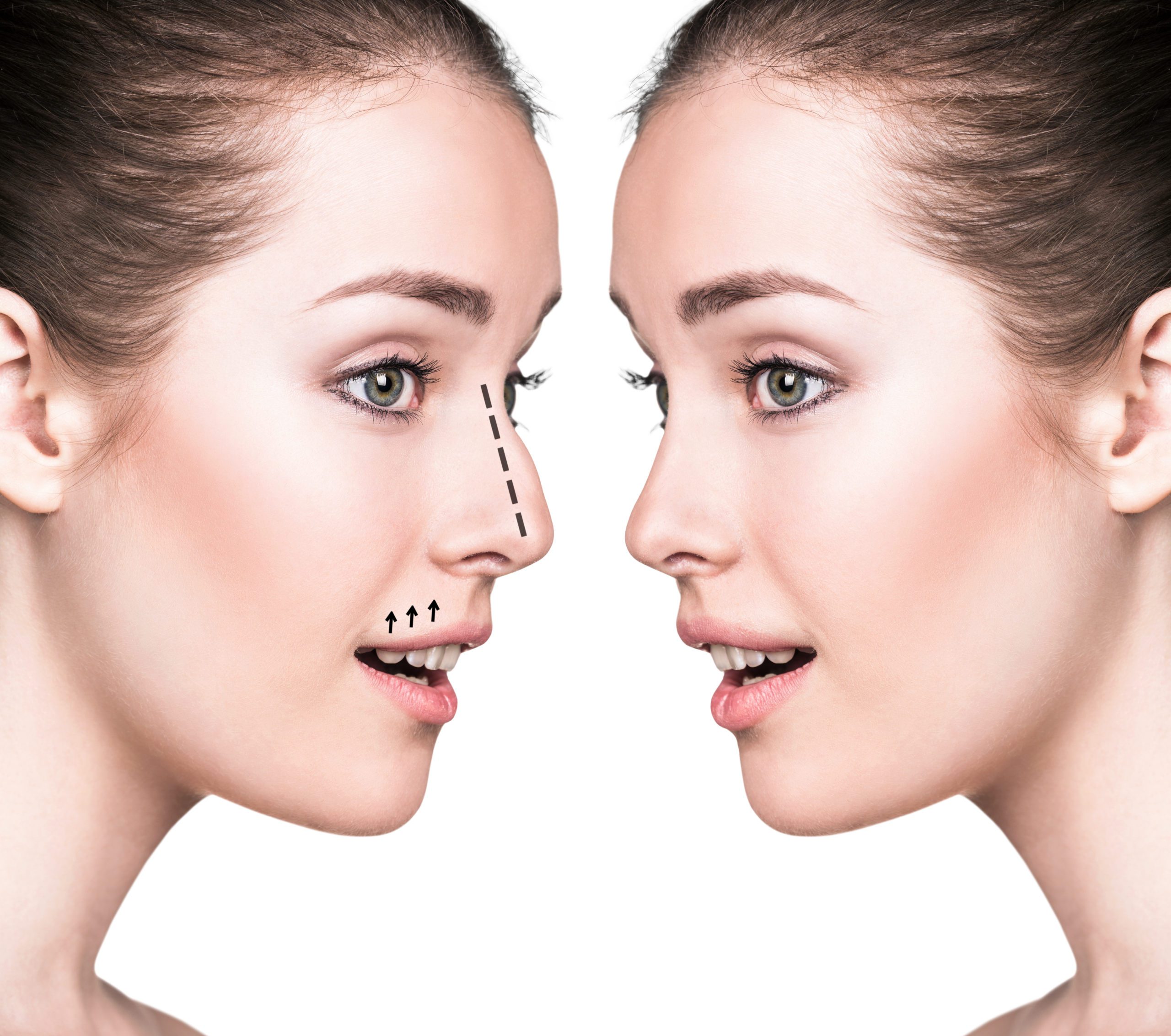 Nose Reshaping