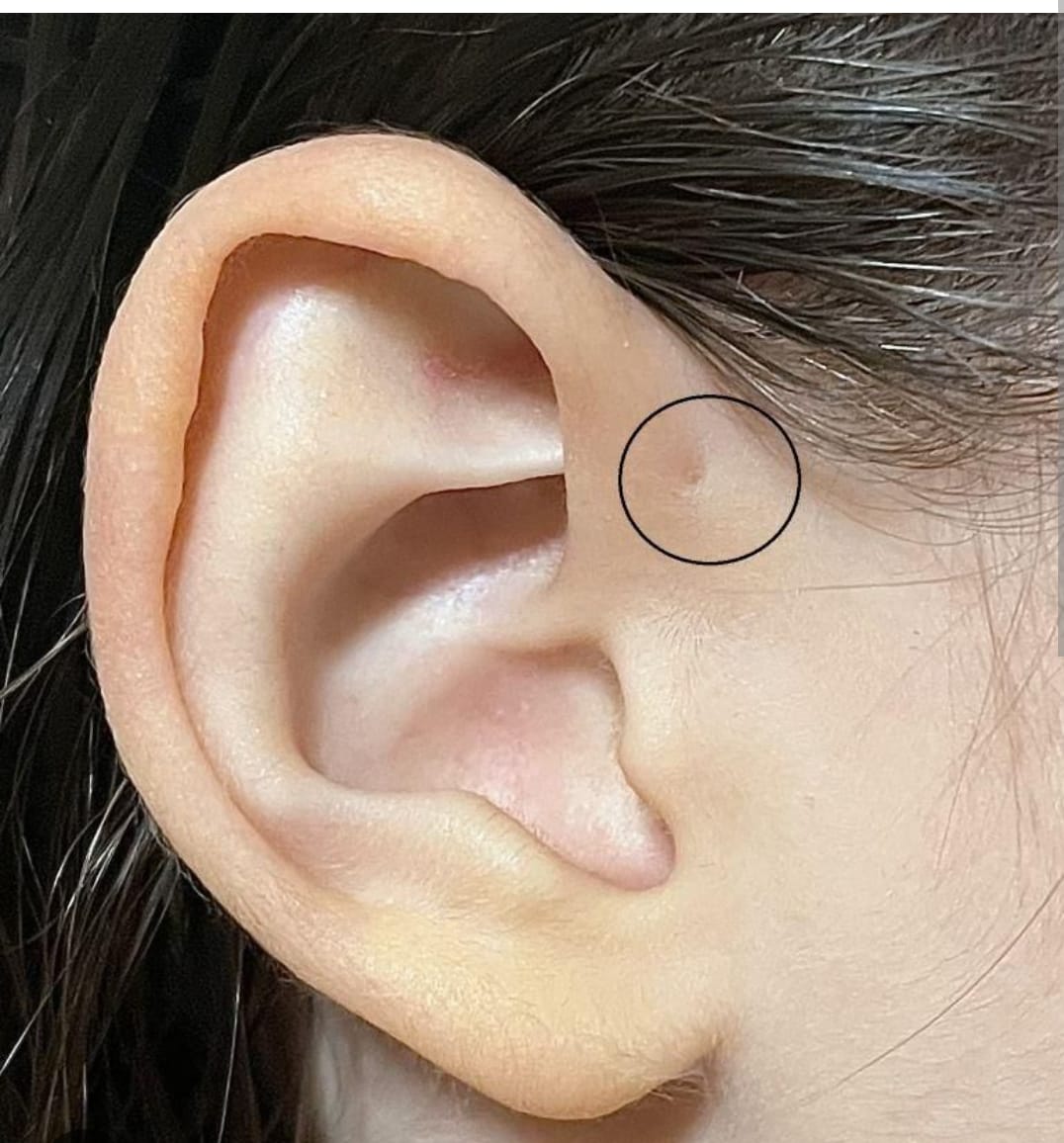 Preauricular Sinus Removal