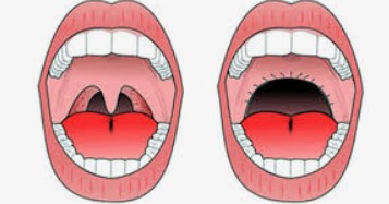 Snoring Surgery ( cold Steel or laser or coblation UVPP)