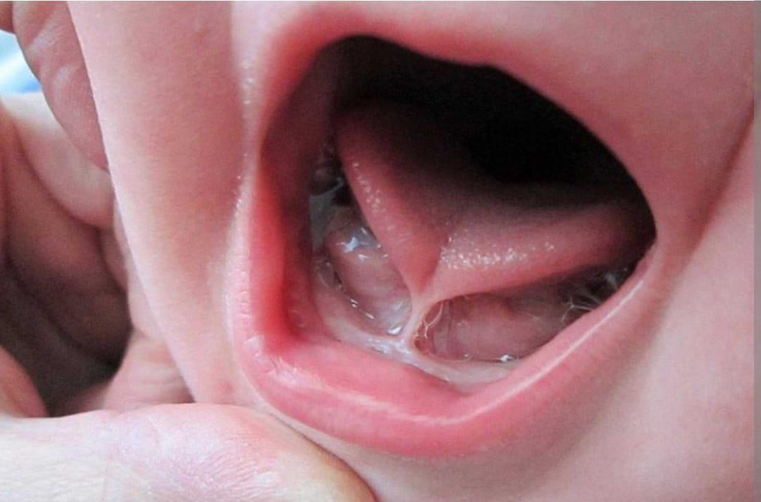 Tongue Tie release surgery