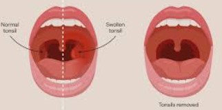 Tonsil Removal (cold Steel or coblation tonsillectomy)
