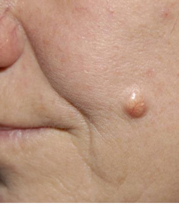 Facial cysts removal available
