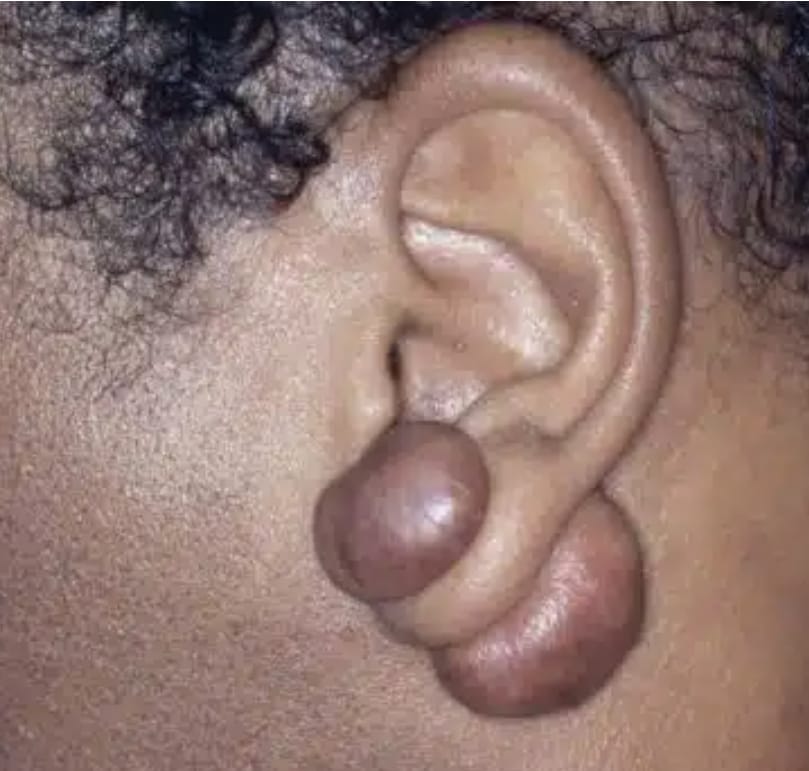 Keloids removal surgery available