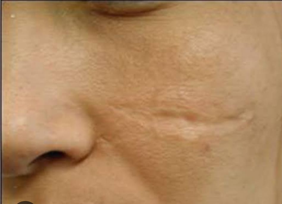 Scar revision surgery available.