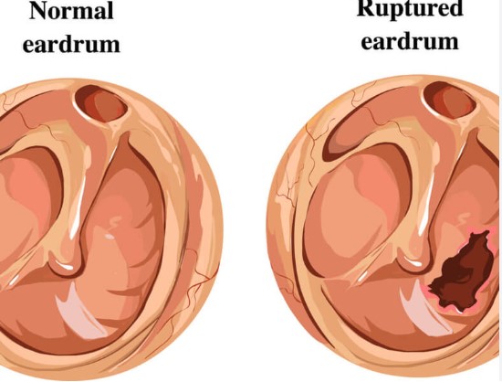 Ear Drum Perforation Repair (Myringoplasty)